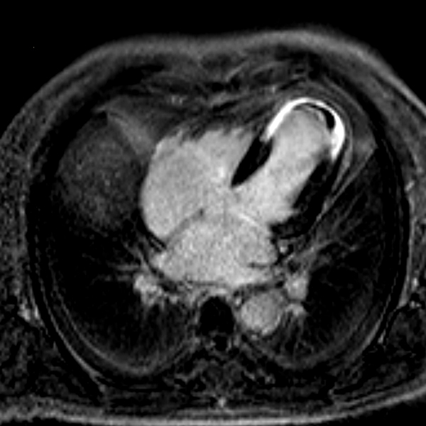 Herz 5. LE und Thrombus